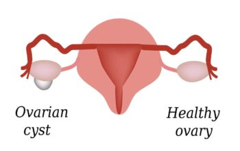 Testosterone Deficiency in Women