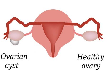 Testosterone Deficiency in Women