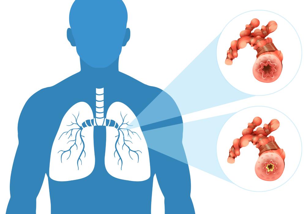 Diagram illustrating the progression of COPD.