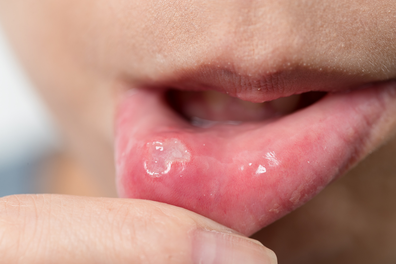 A person treating mouth ulcer with amlexanox