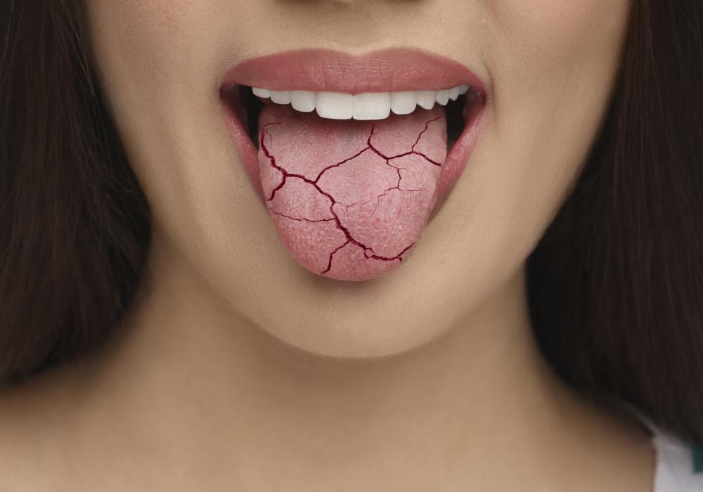 Close-up image of a dry mouth, characterized by a lack of saliva, leading to a parched and cracked appearance of the tongue and inner cheeks