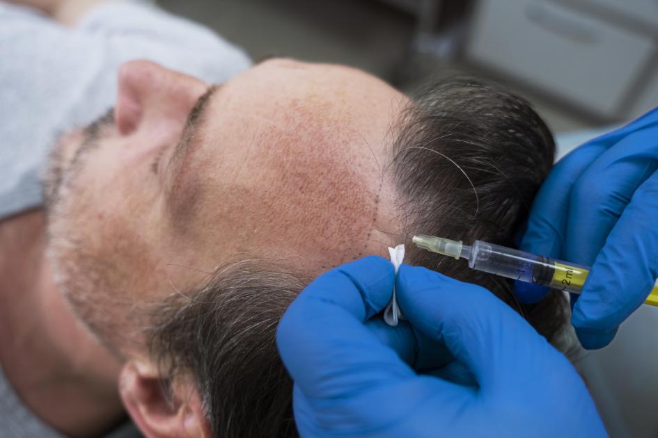 Peptide Therapy for Hair Loss